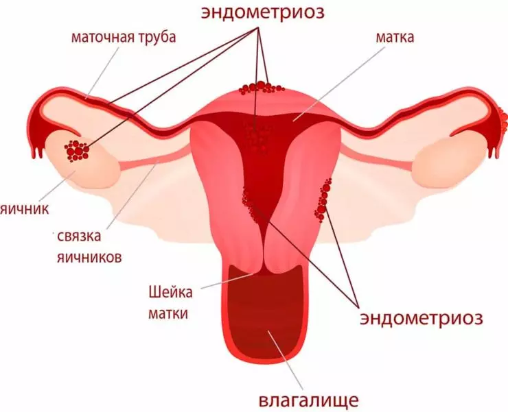 Схема - эндометриоз